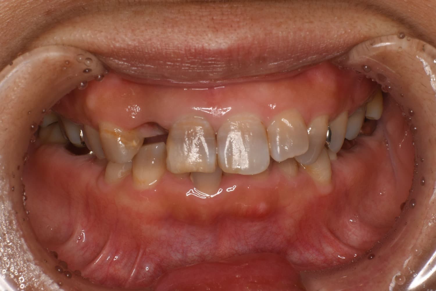 インプラント治療前:右上2番目の歯を抜歯した状態