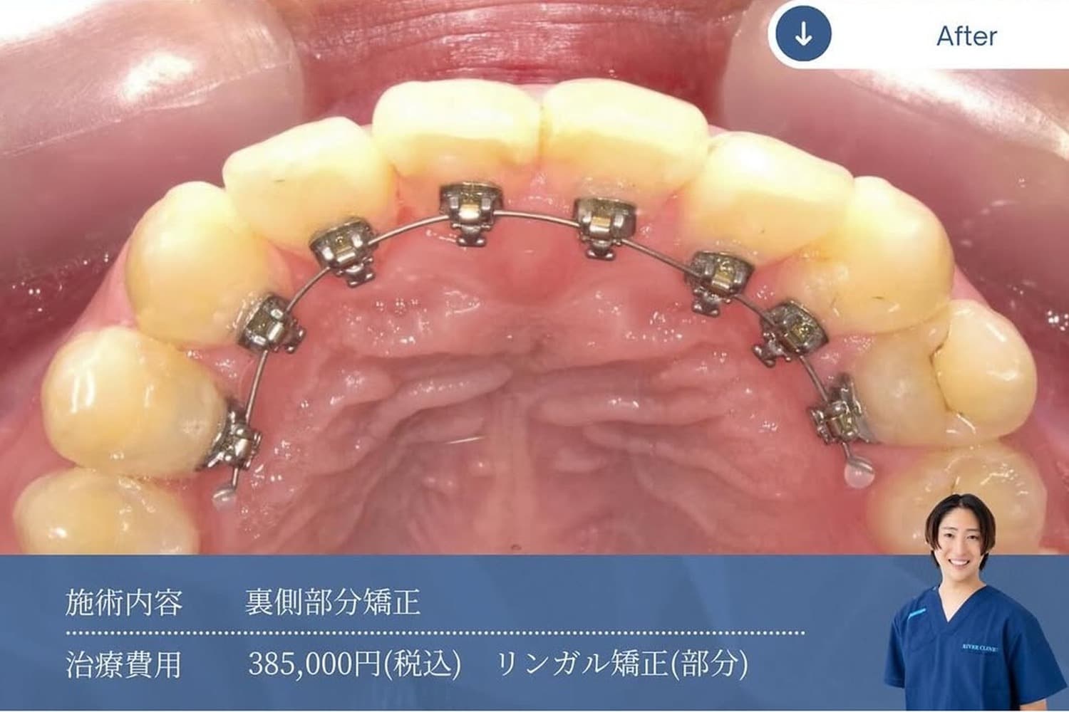 矯正治療後