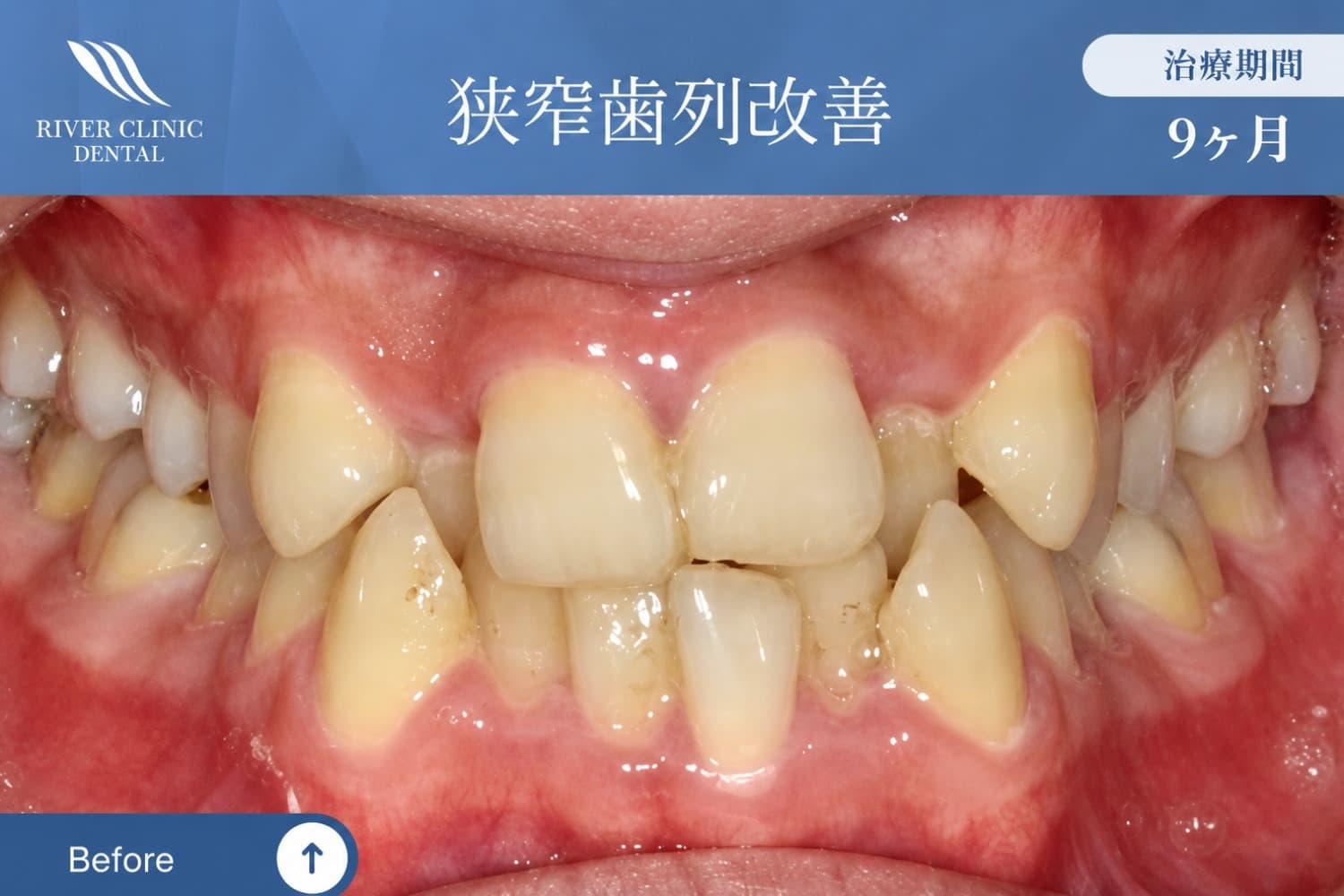 矯正治療前