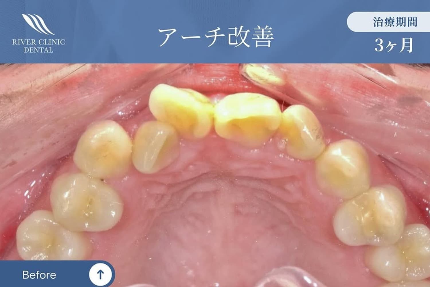 矯正治療前