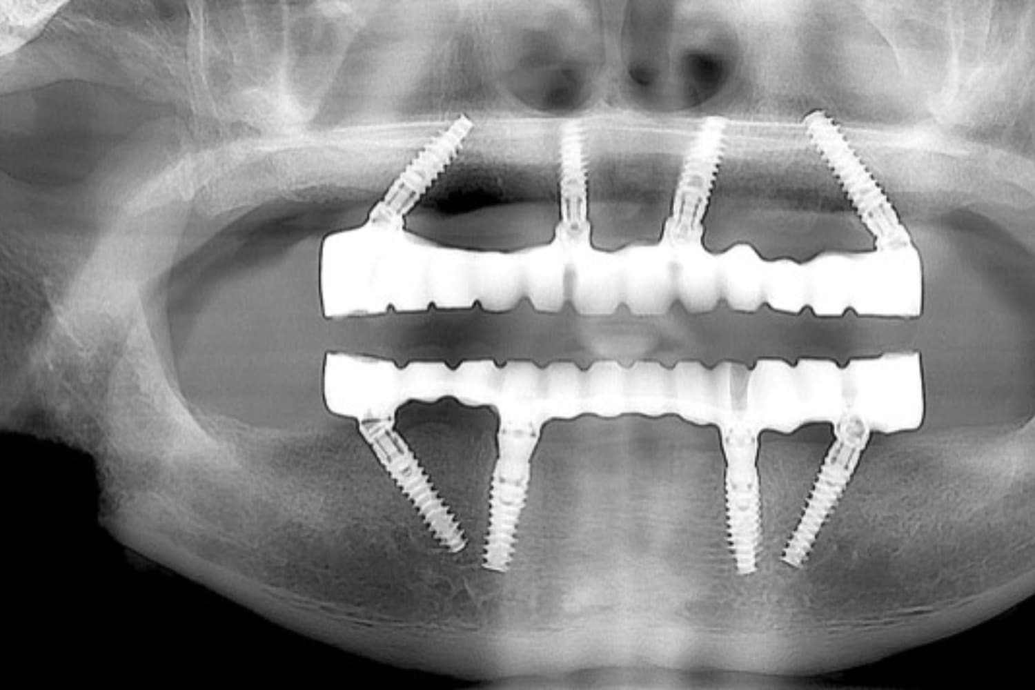 インプラント治療後(レントゲン)