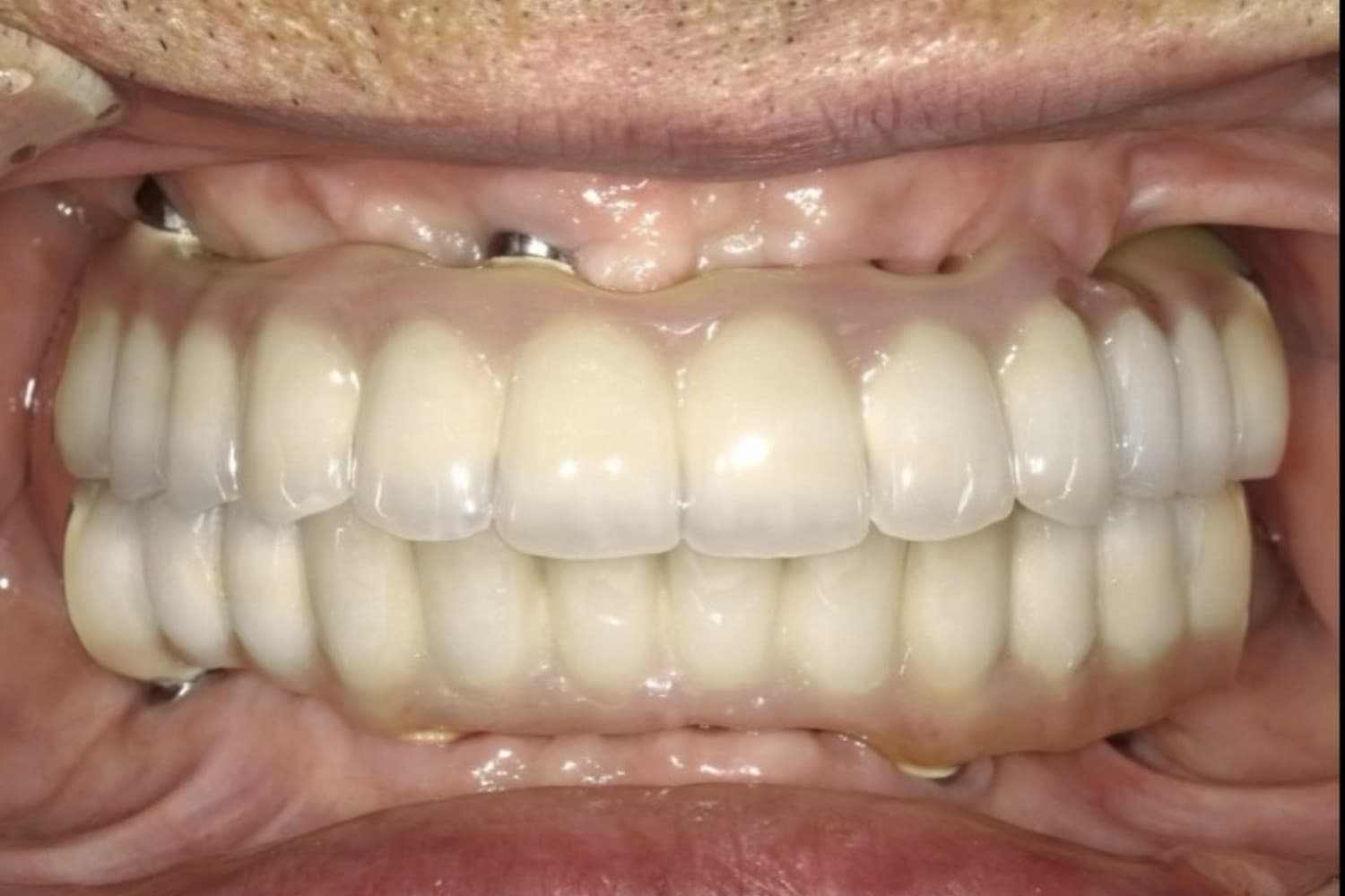 インプラント治療後