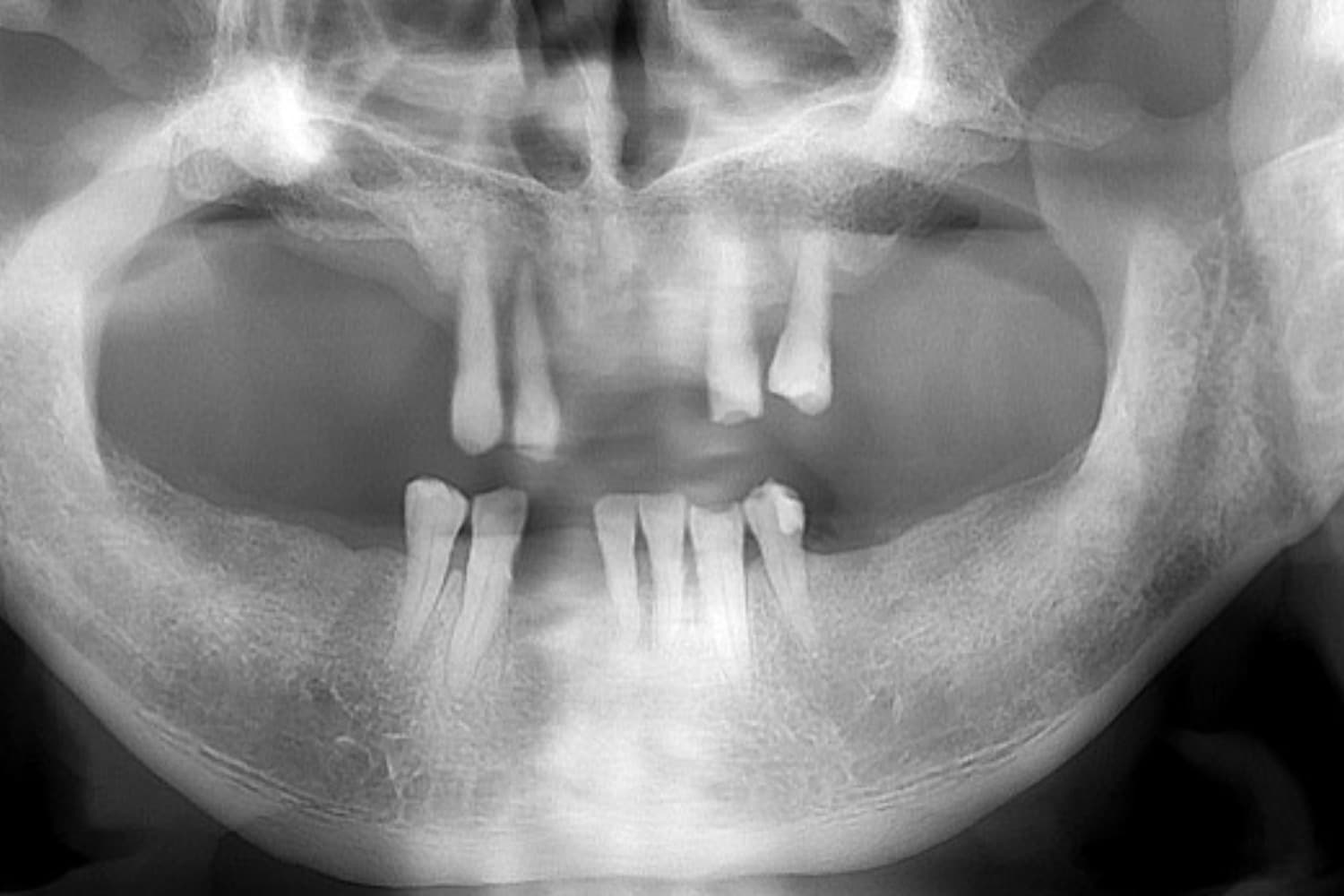 インプラント治療前(レントゲン)