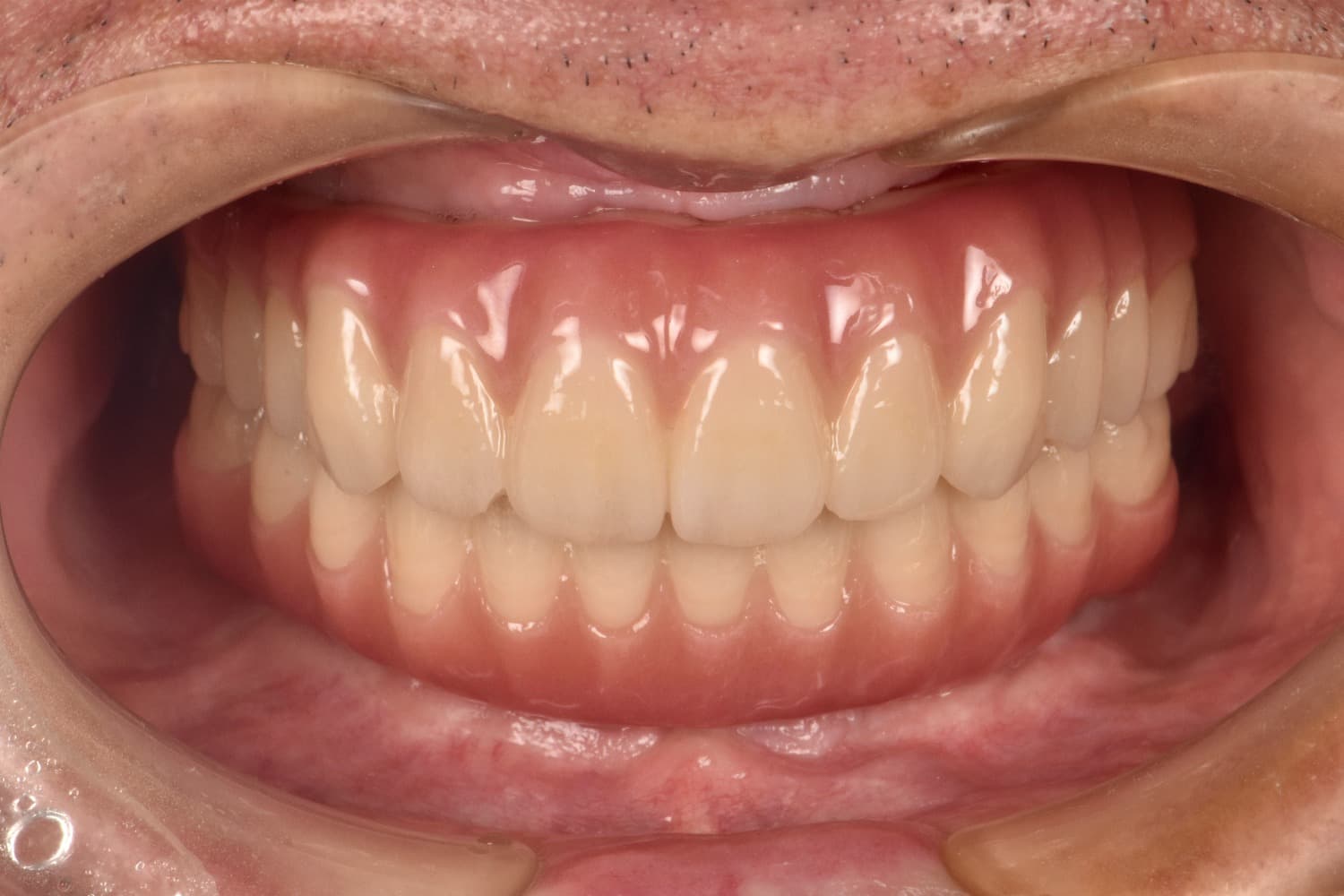 インプラント治療後