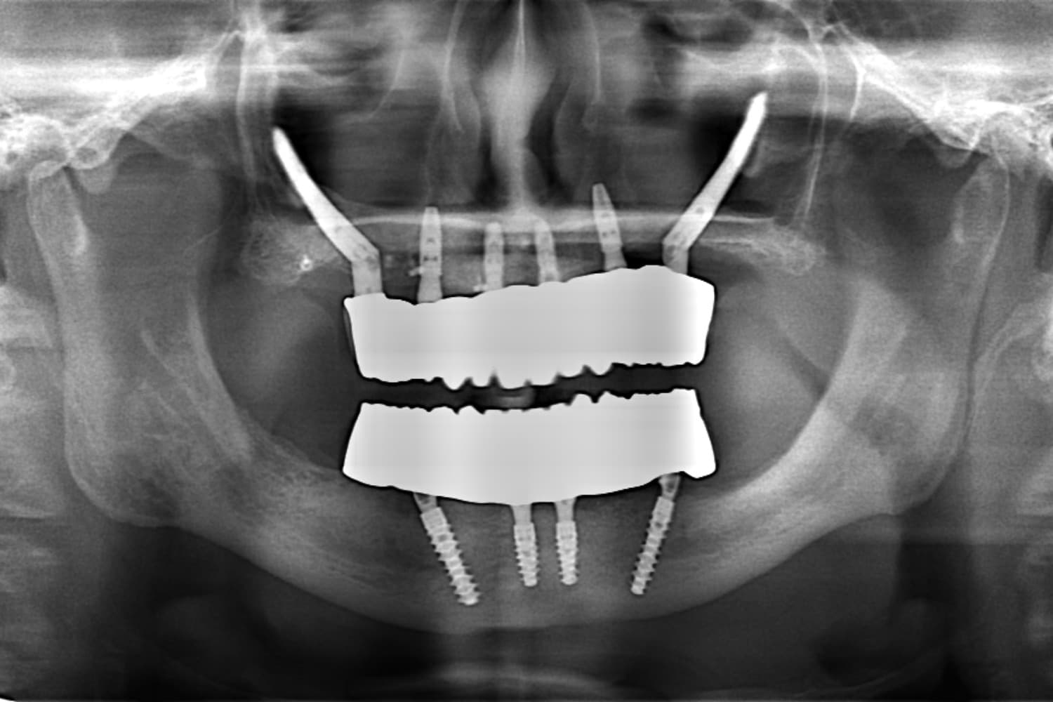 インプラント治療後(レントゲン)