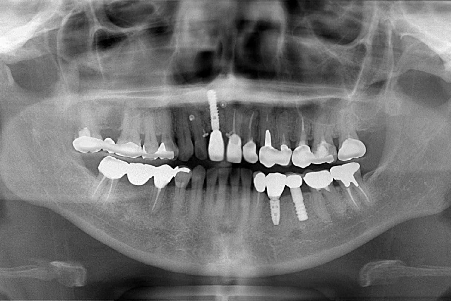 インプラント治療後(レントゲン)
