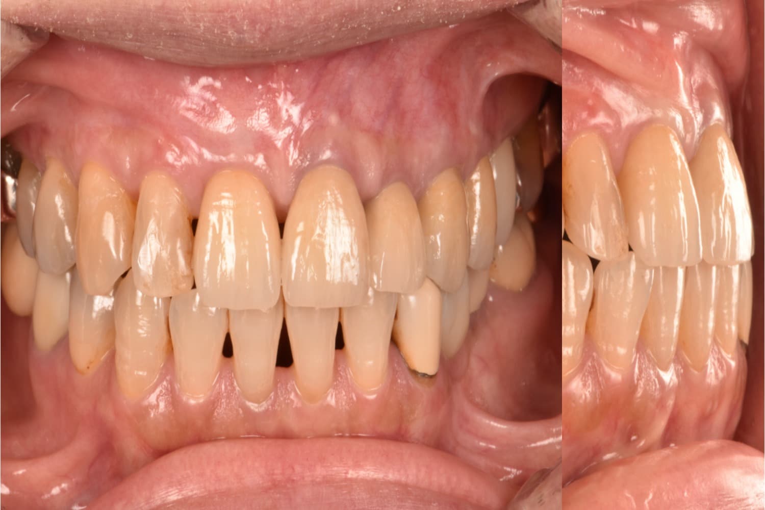 インプラント治療後