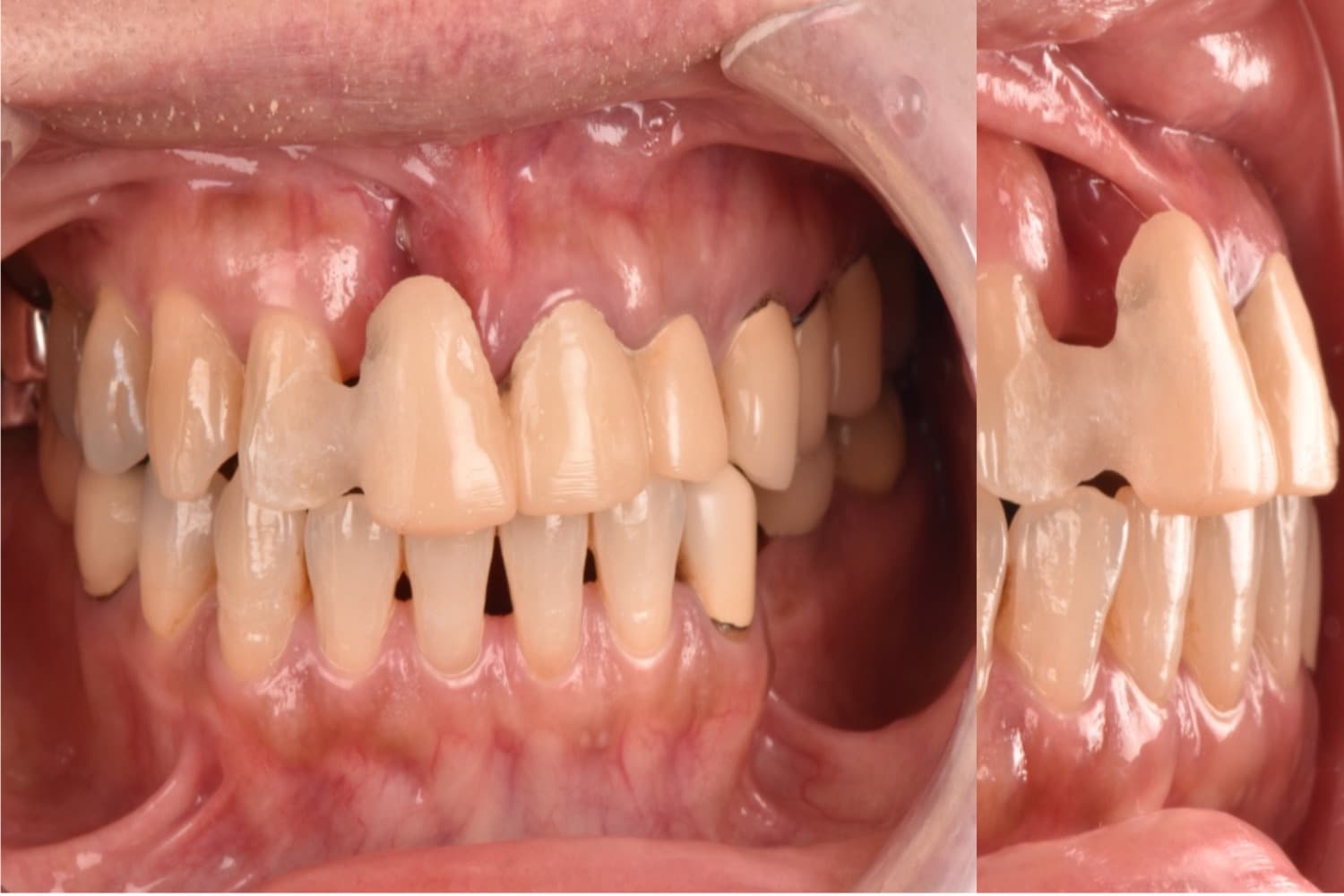 インプラント治療前