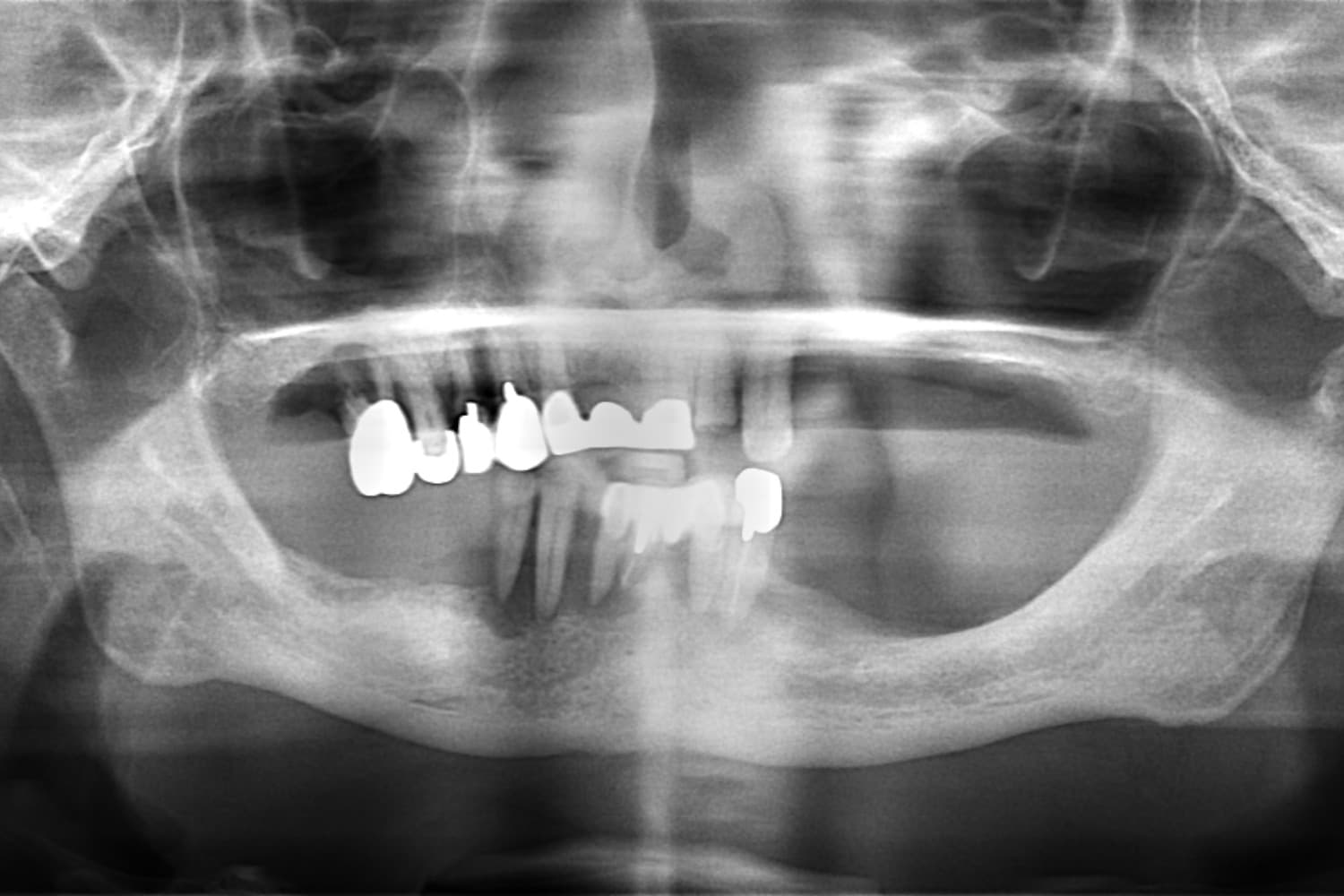 インプラント治療前(レントゲン)