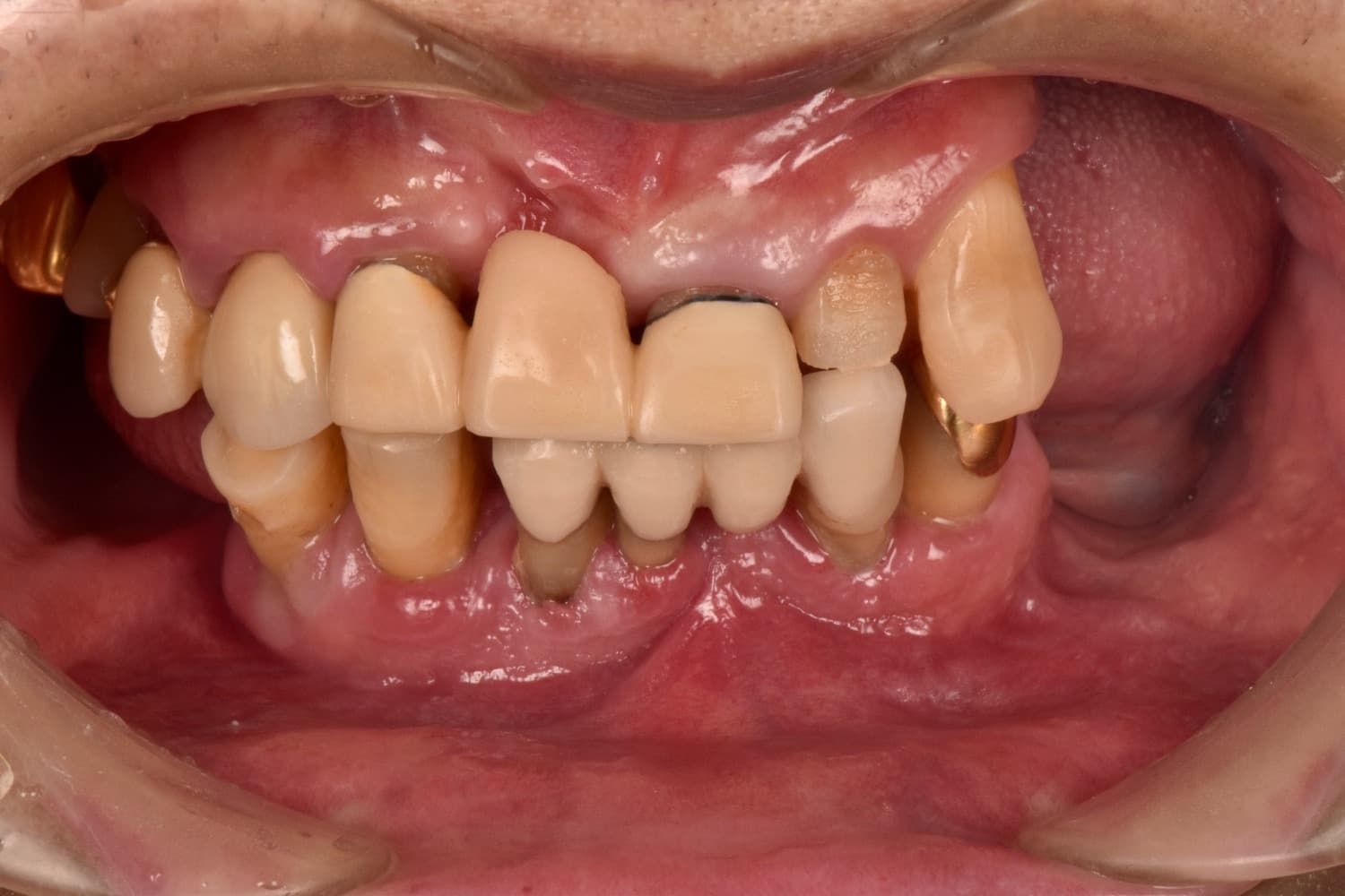 インプラント治療前