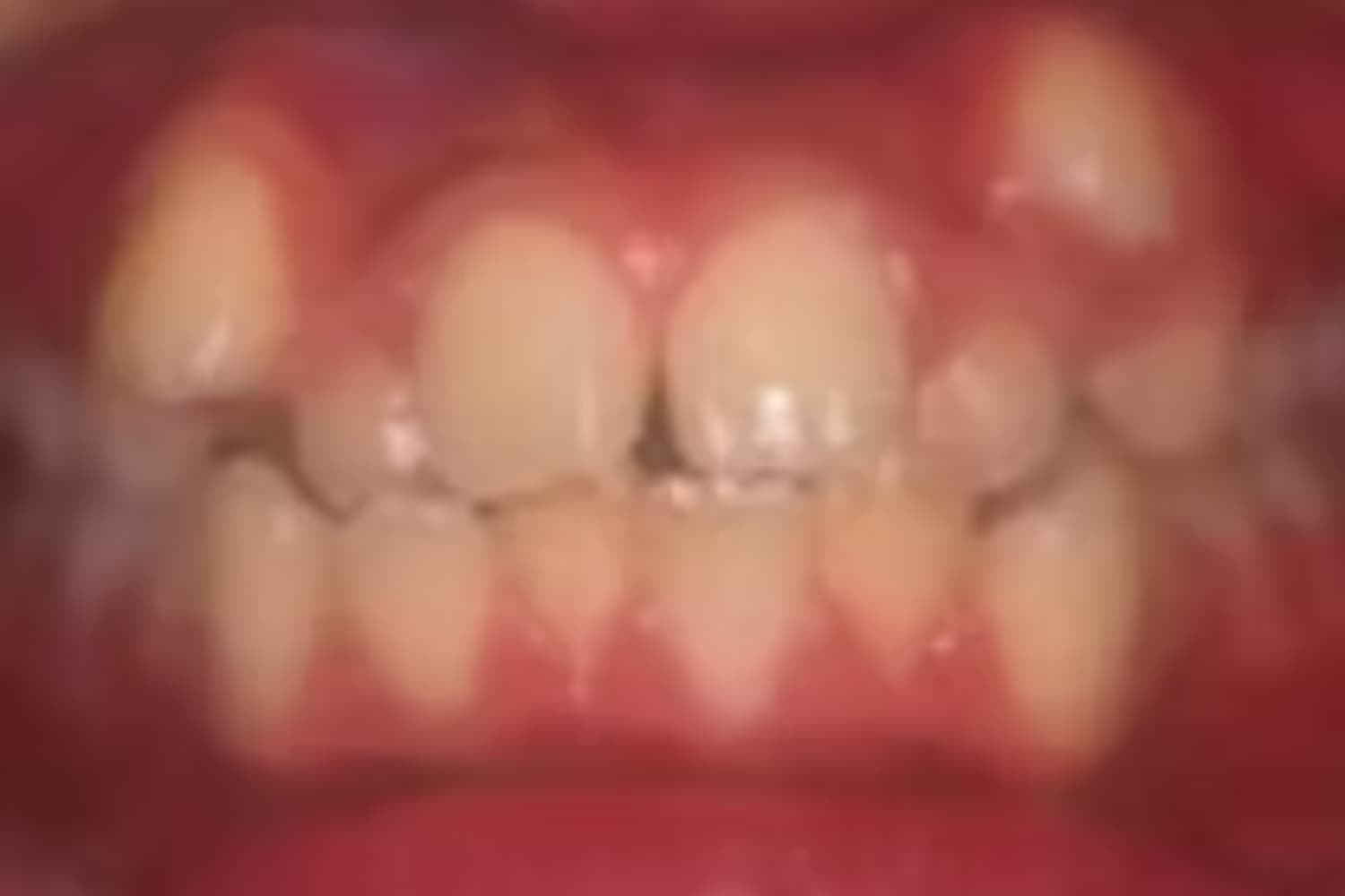 症例①矯正治療前