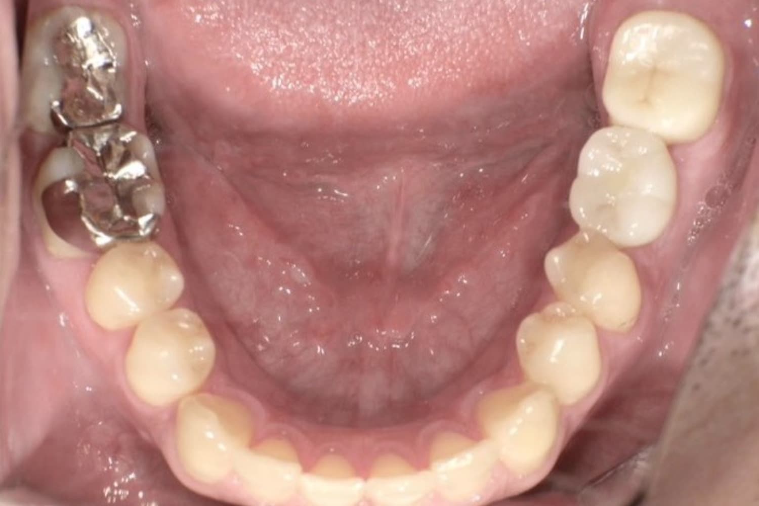 インプラント治療後