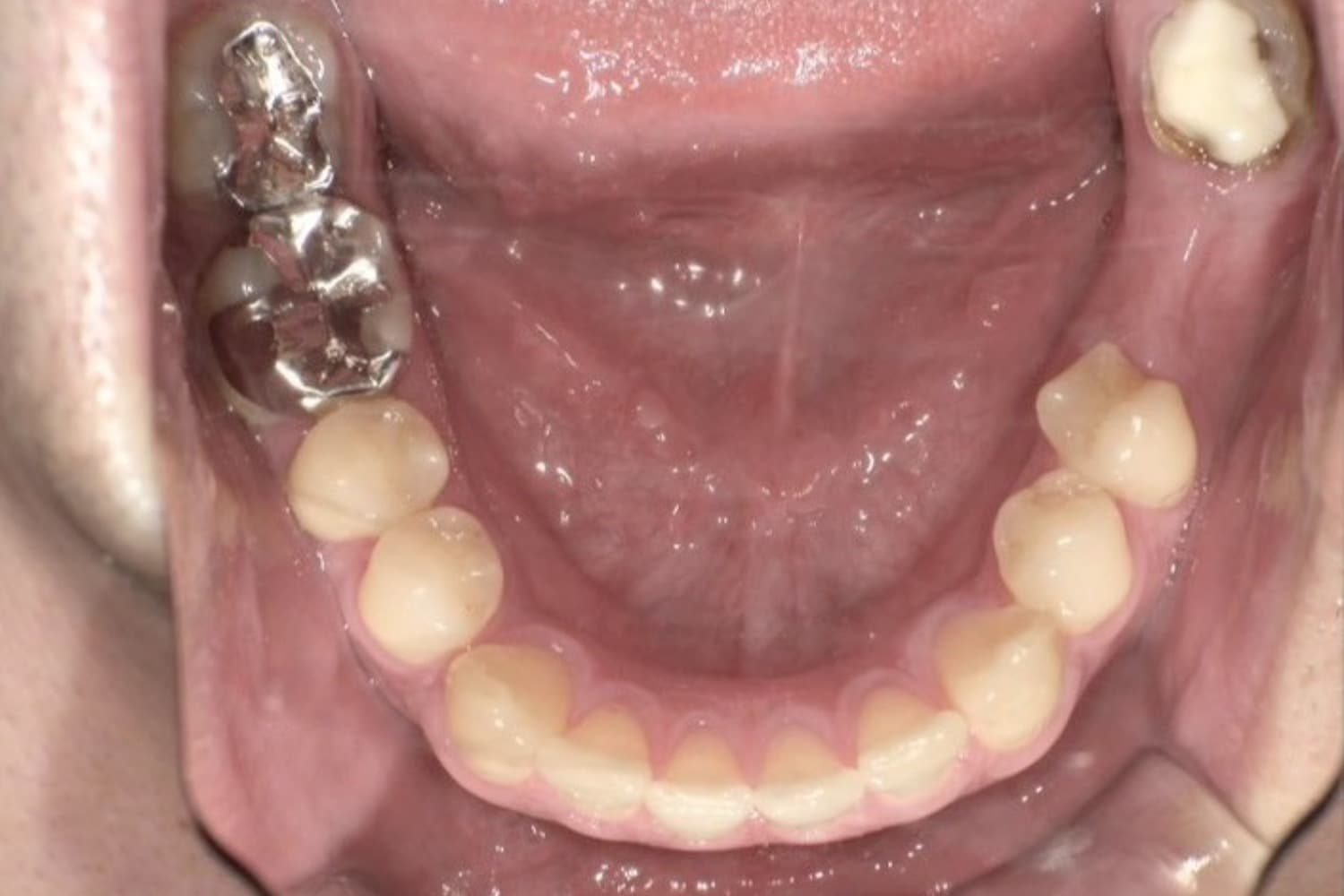 インプラント治療前