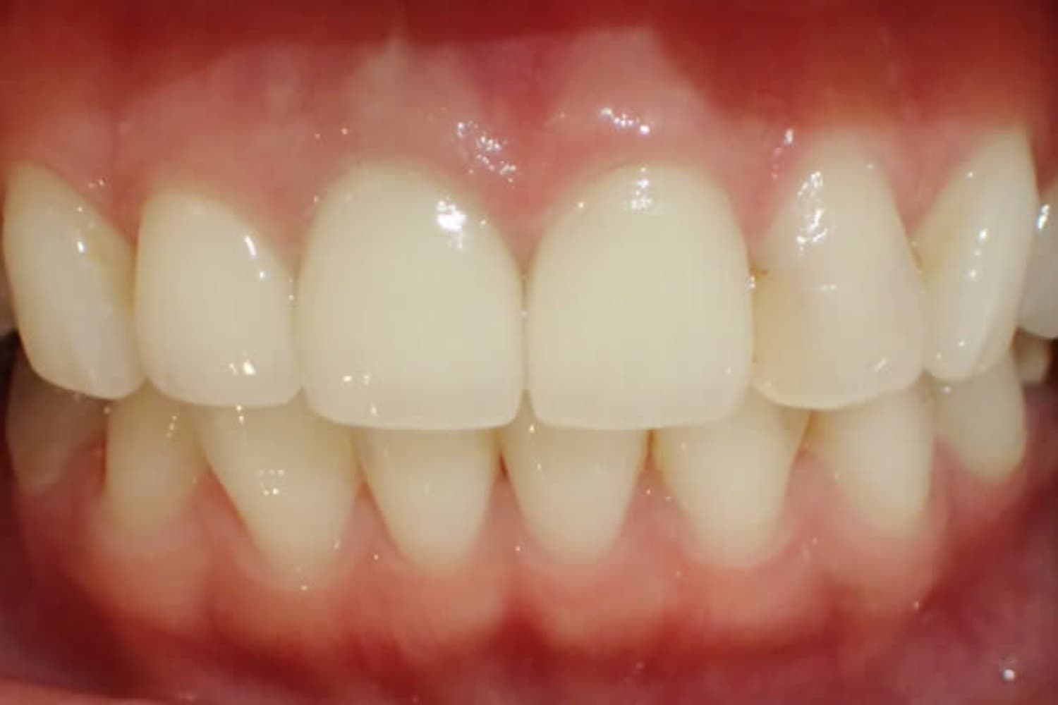 症例⑤セラミック治療後