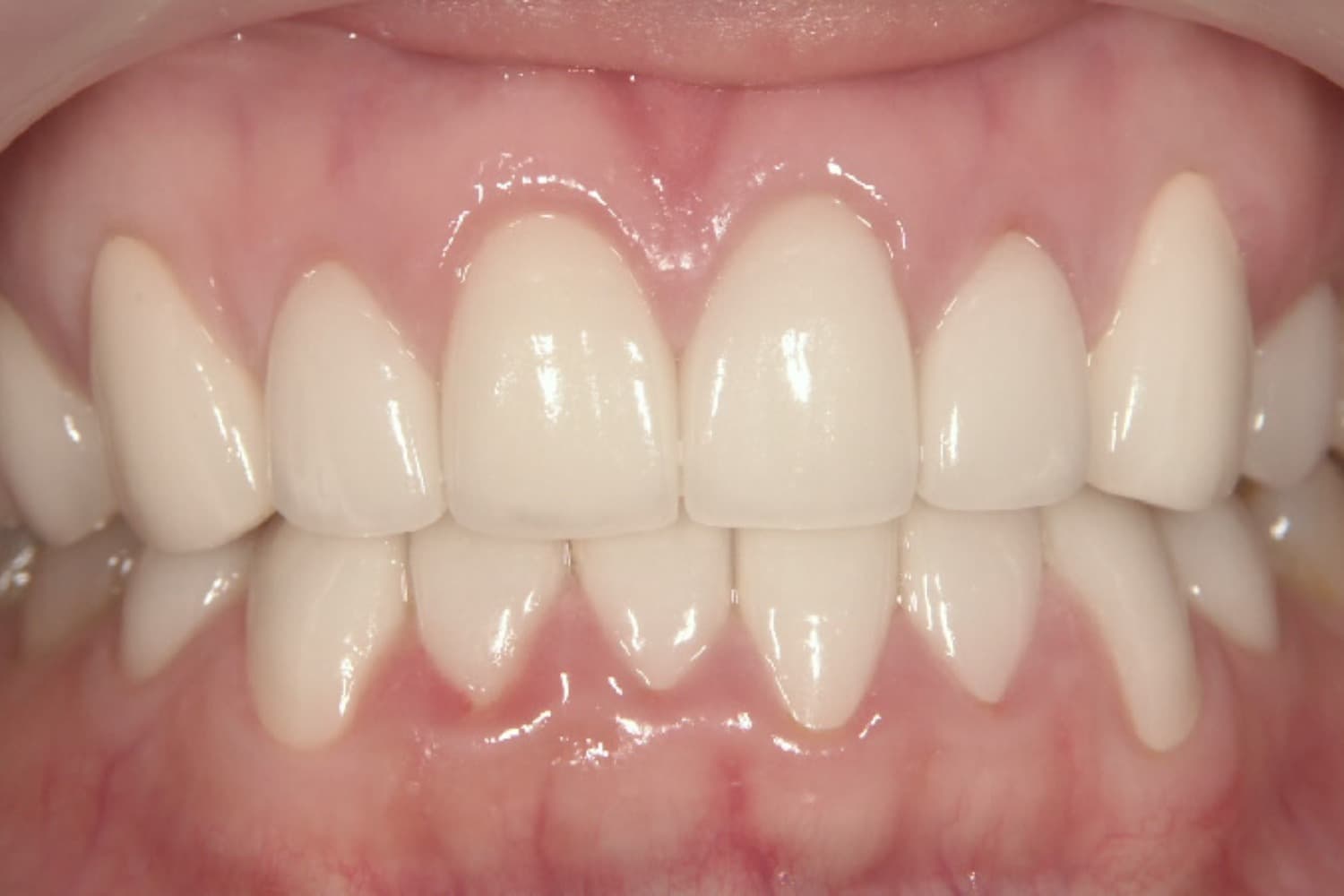 症例④ラミネートベニア治療後