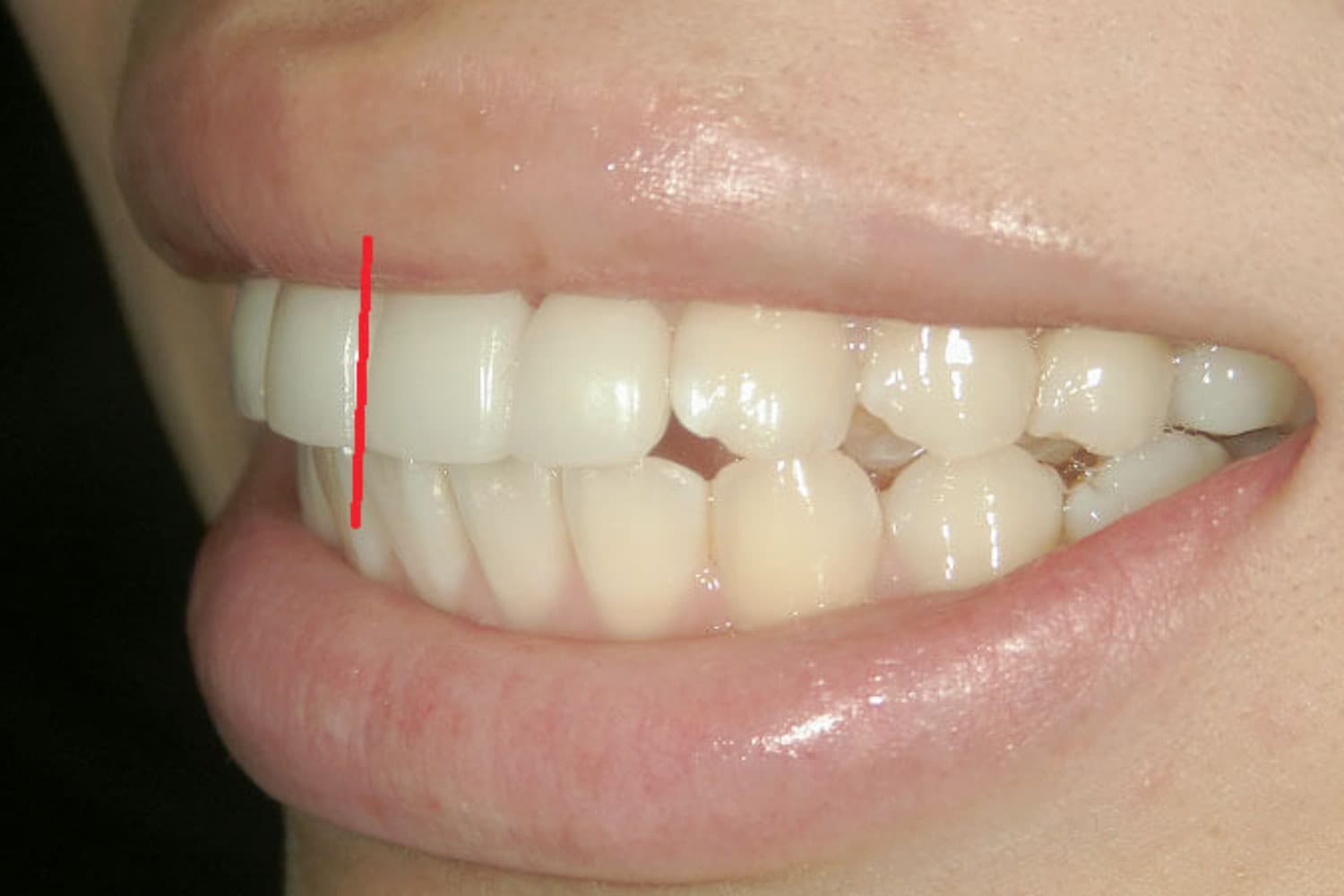 症例②セラミック矯正後2