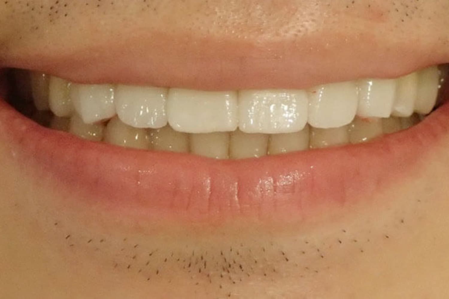 症例③削らないラミネートベニア治療後2