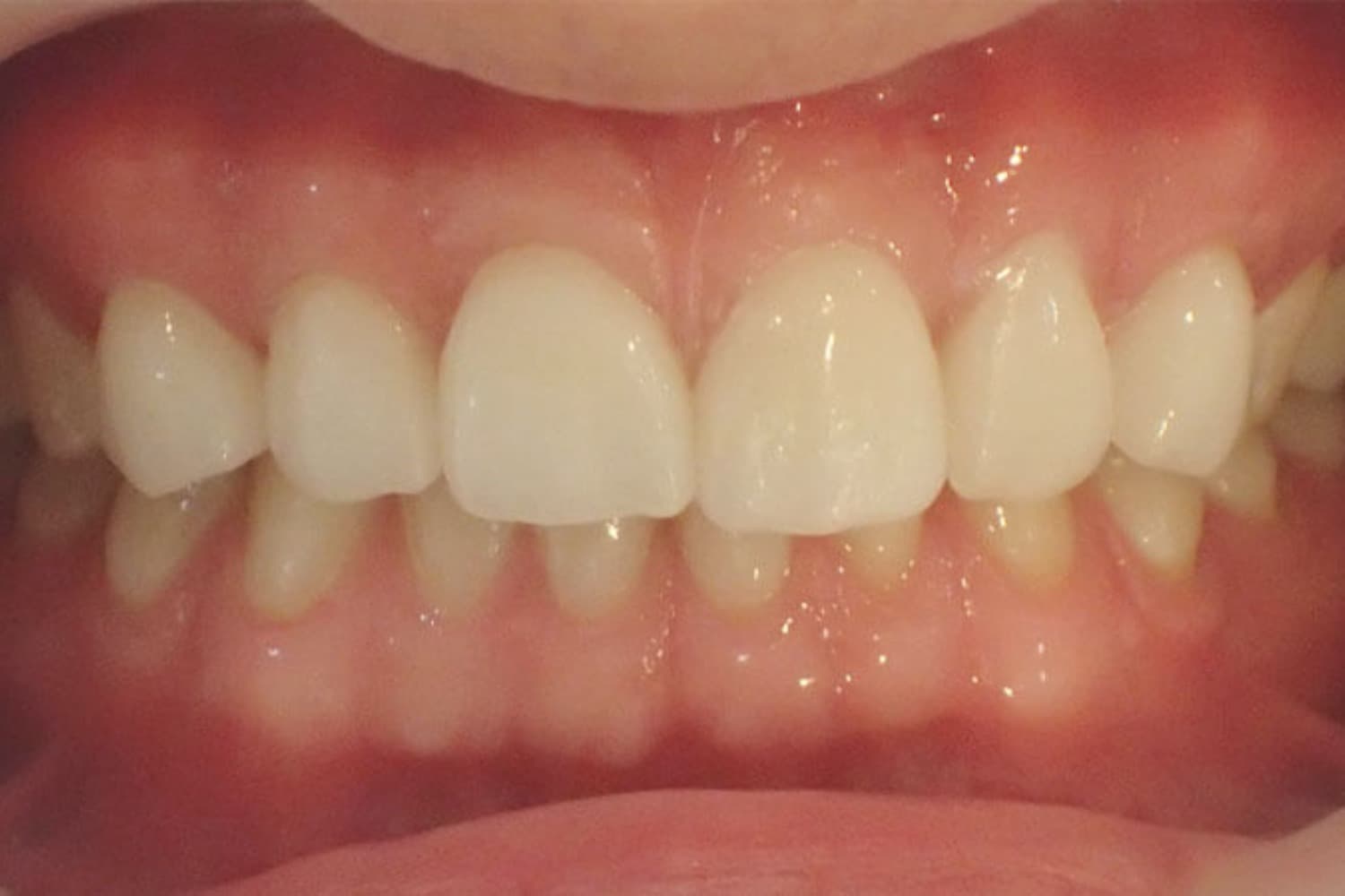 症例③削らないラミネートベニア治療後1