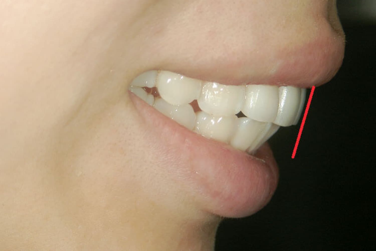 症例②セラミック矯正後1