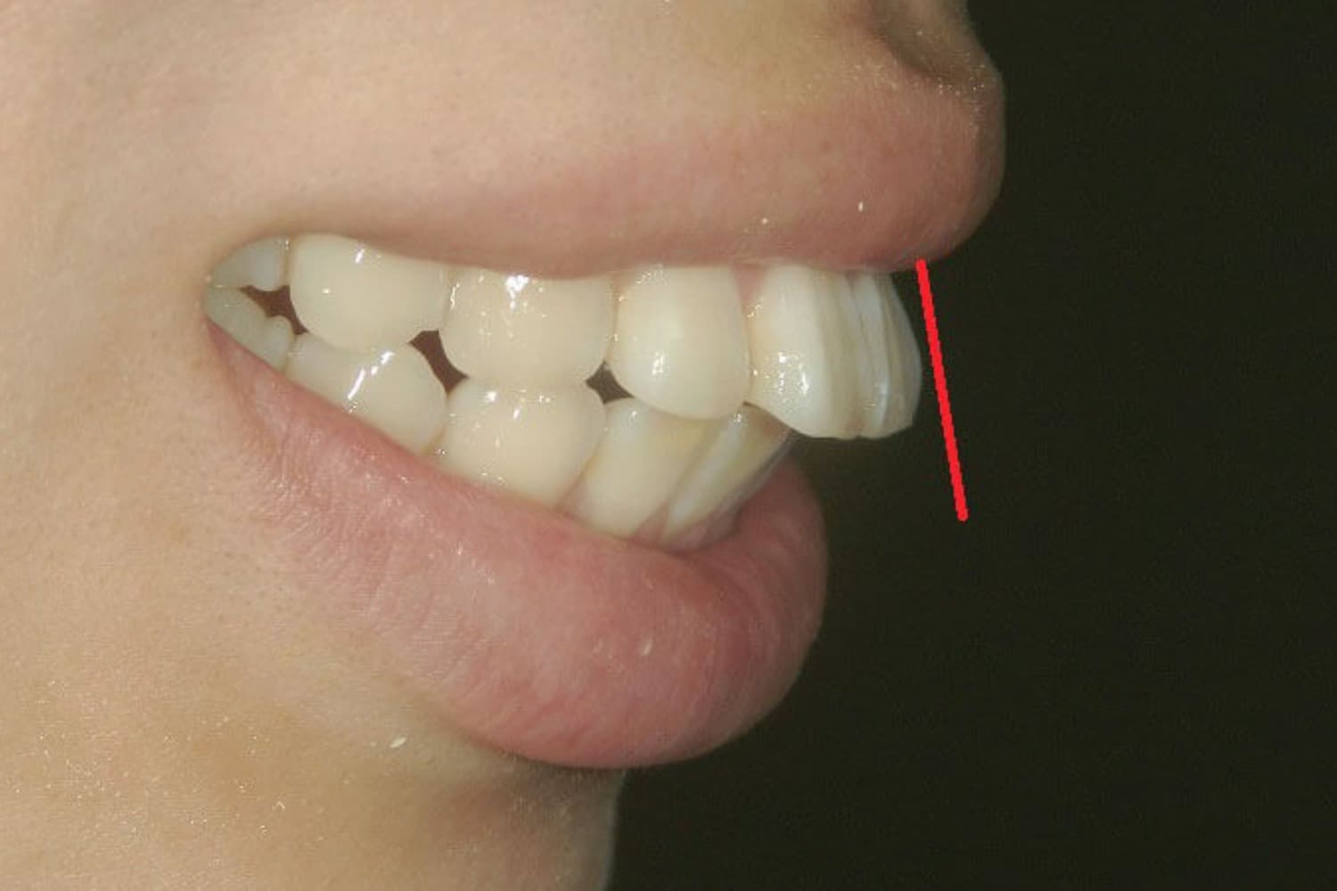 症例②セラミック矯正前1