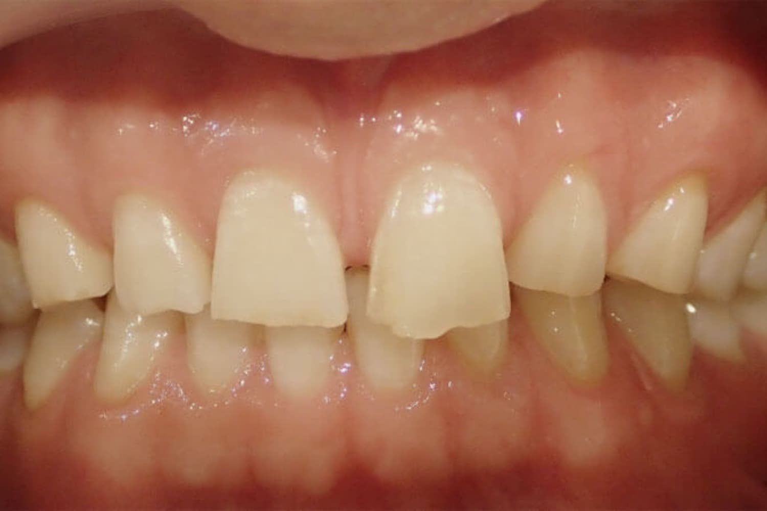 症例③削らないラミネートベニア治療前1