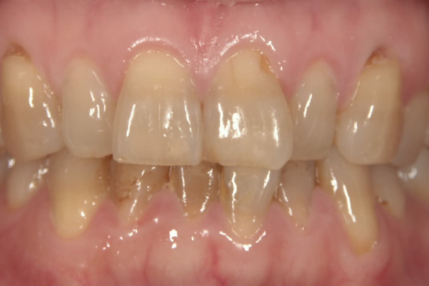 症例④ラミネートベニア治療前