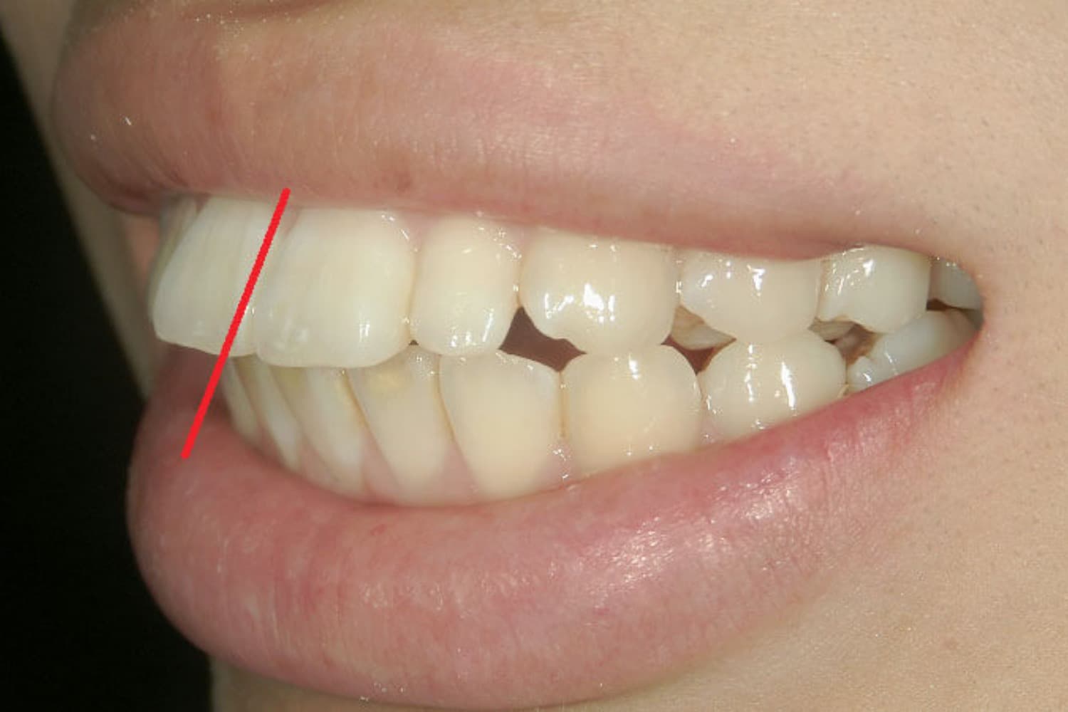 症例②セラミック矯正前2