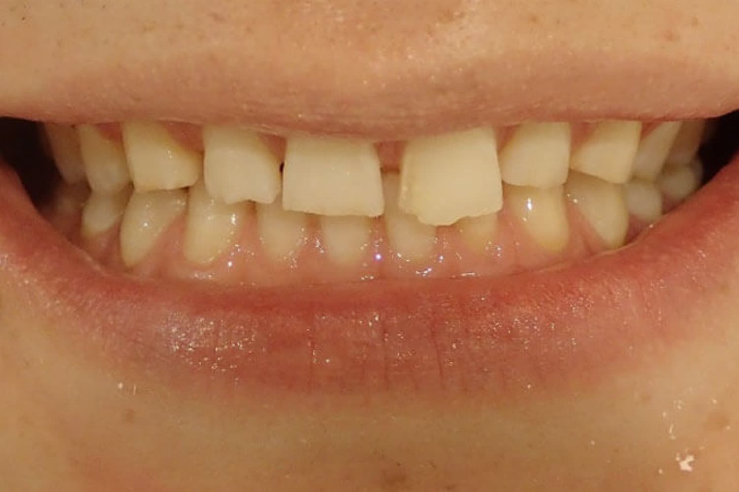 症例③削らないラミネートベニア治療前2