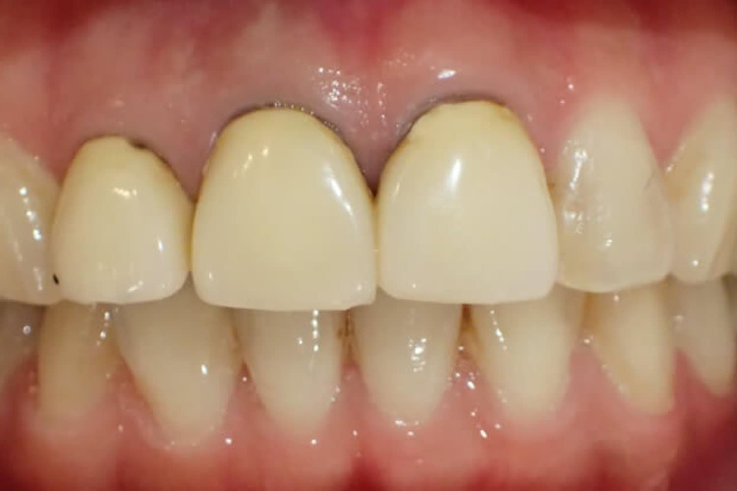 症例⑤セラミック治療前