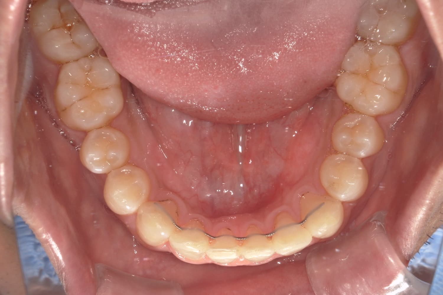 症例⑤矯正治療後