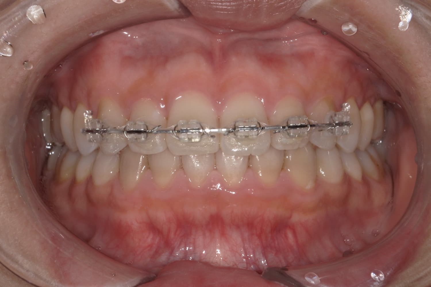 症例④矯正治療後