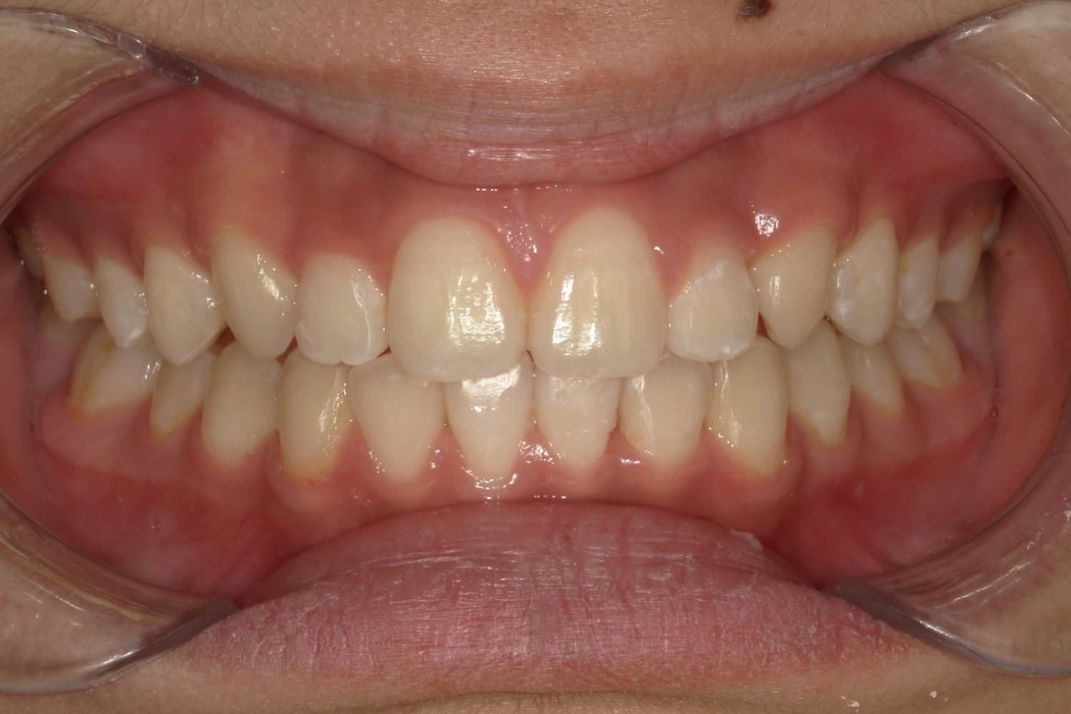 症例①矯正治療後