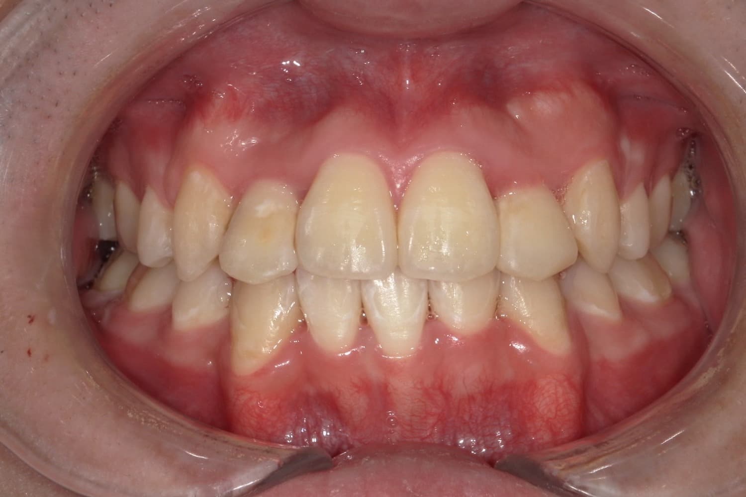 症例③矯正治療後