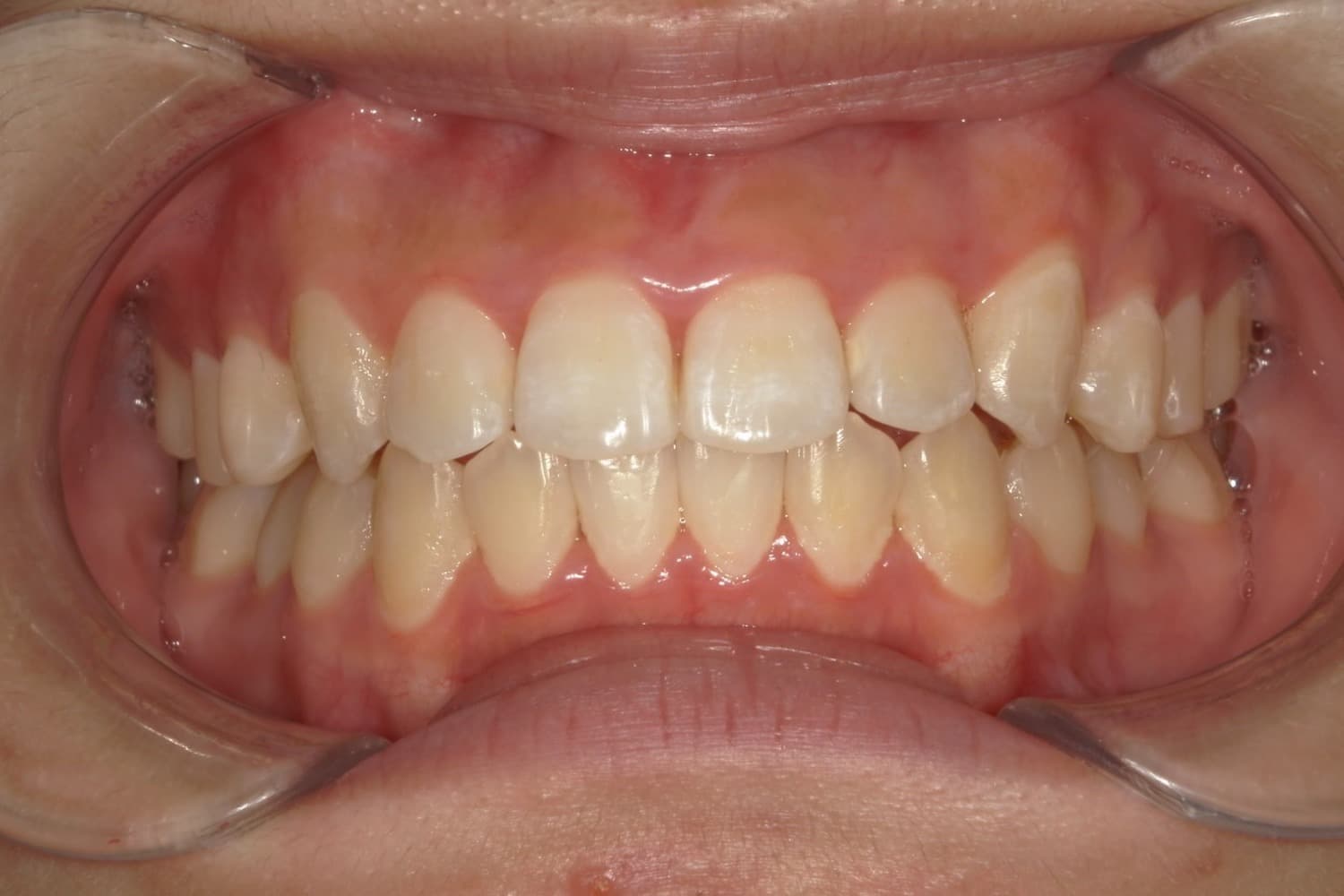 症例②矯正治療後