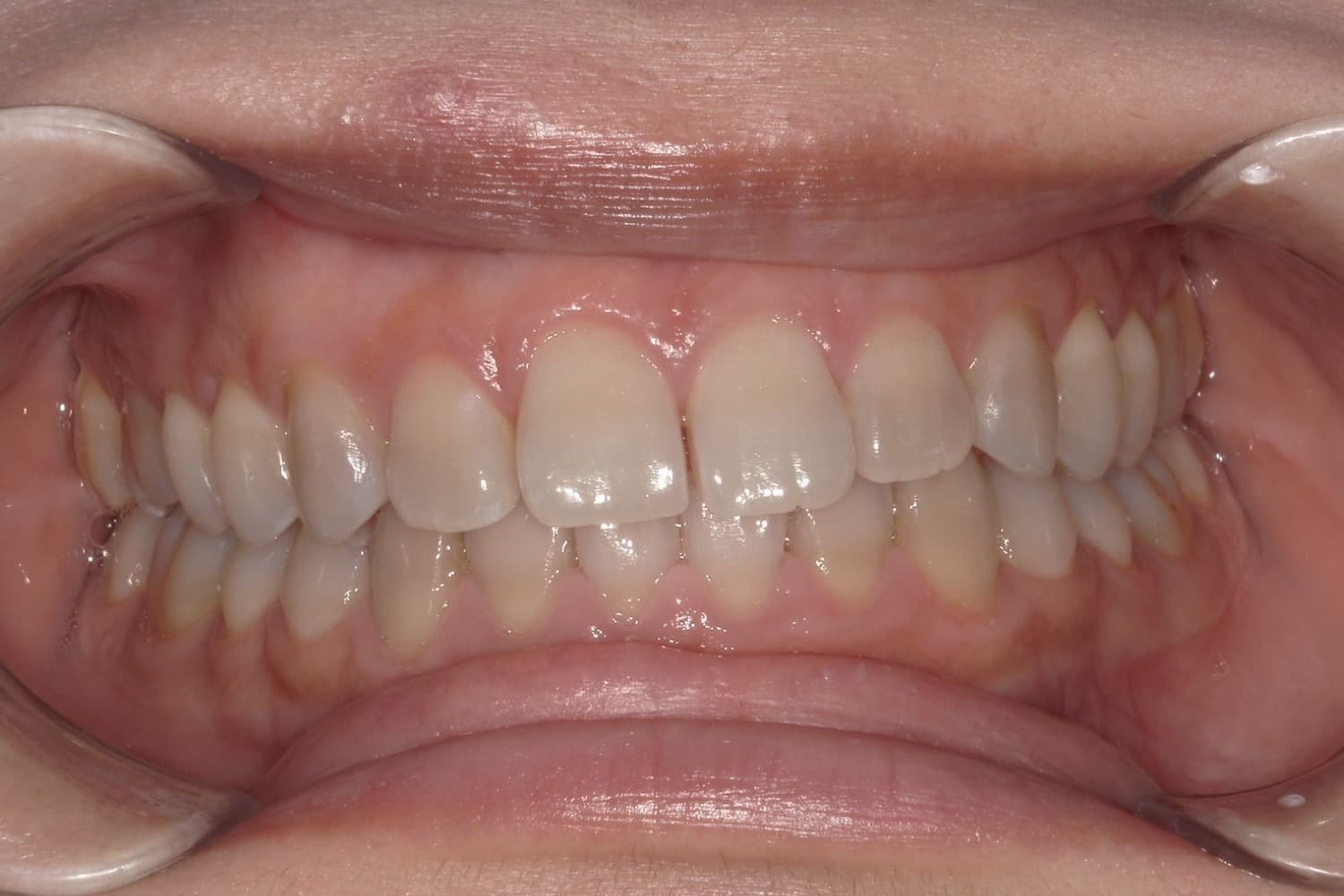 症例④矯正治療前