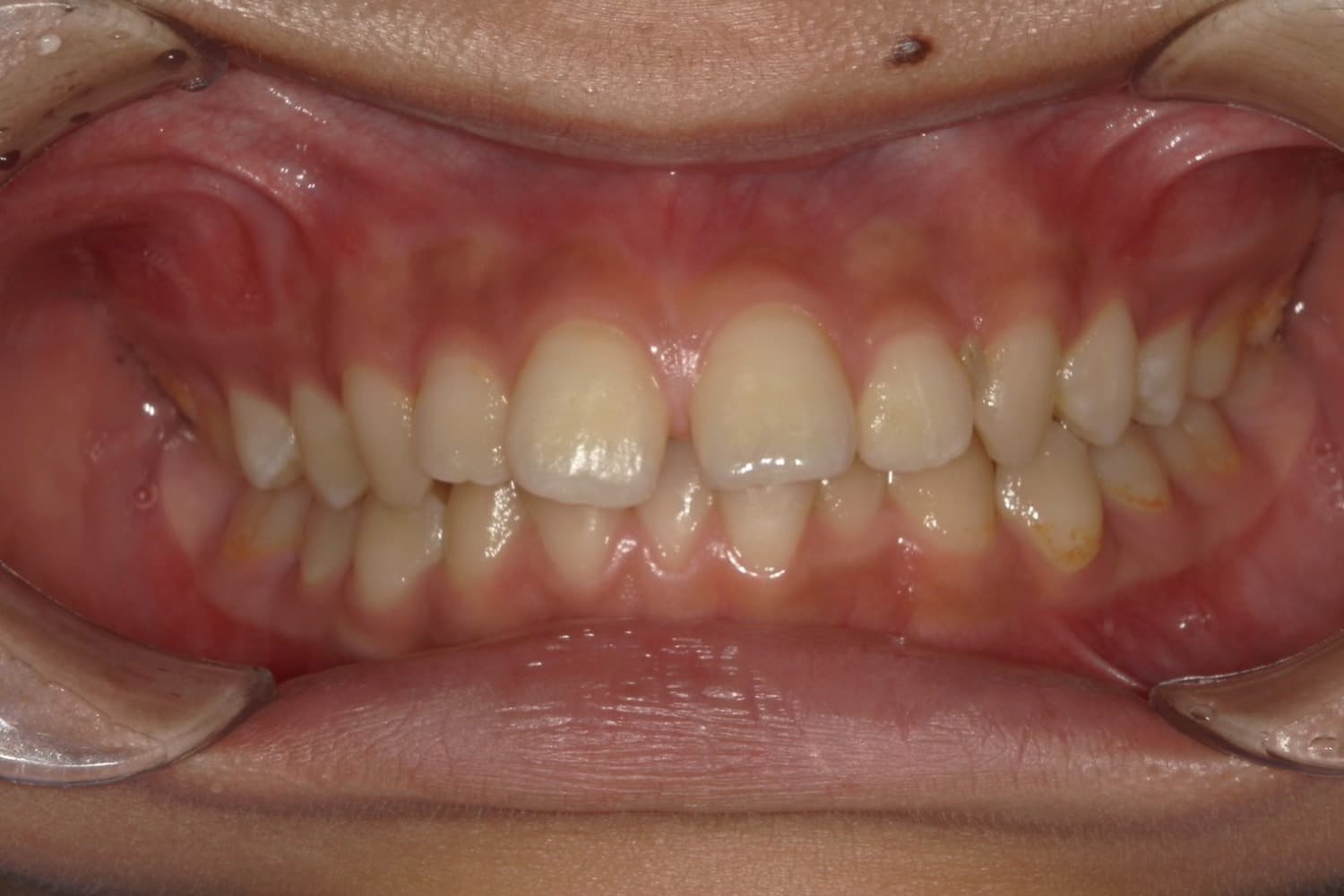 症例①矯正治療前