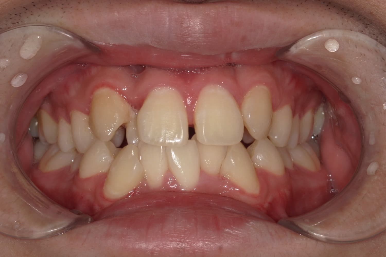 症例③矯正治療前