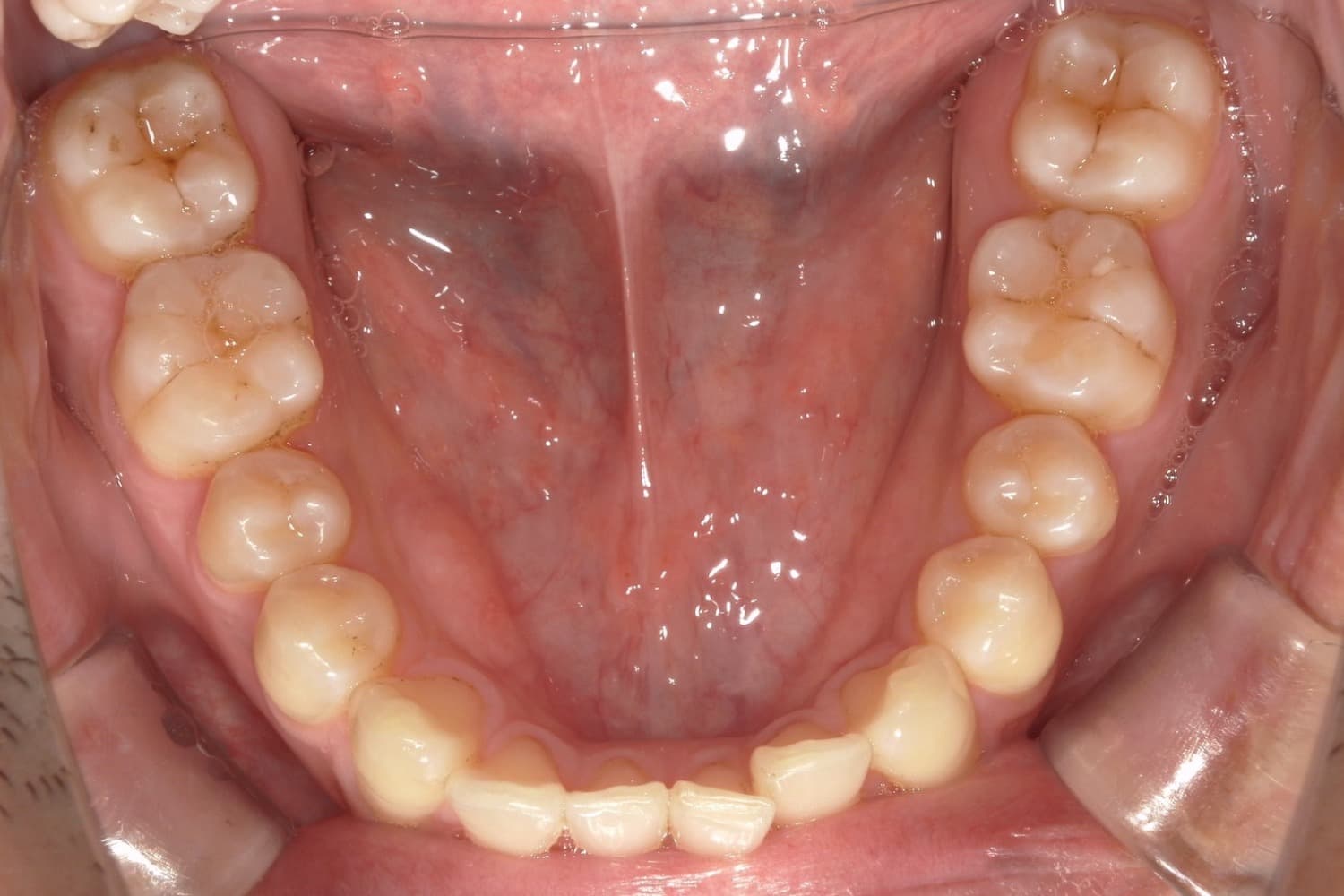 症例⑤矯正治療前