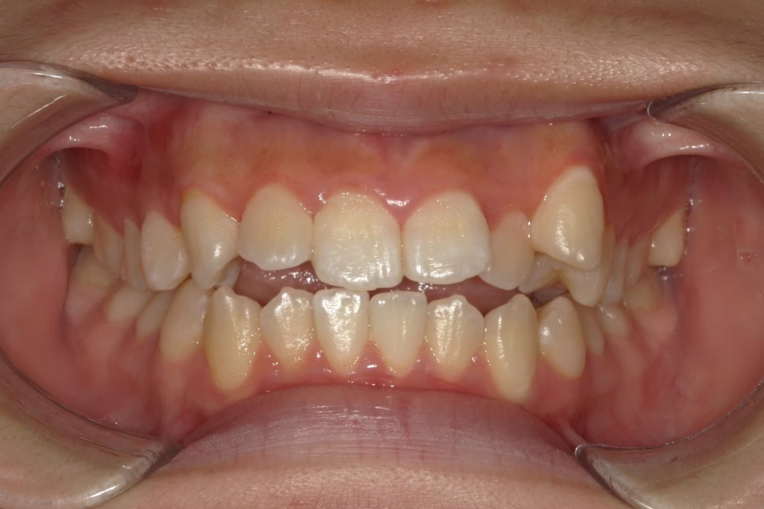 症例②矯正治療前