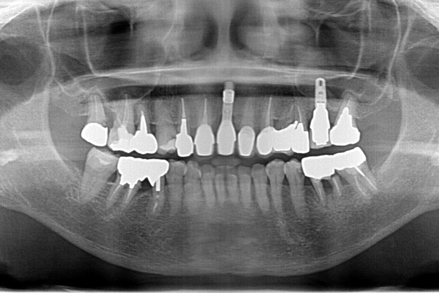 症例②インプラント治療後