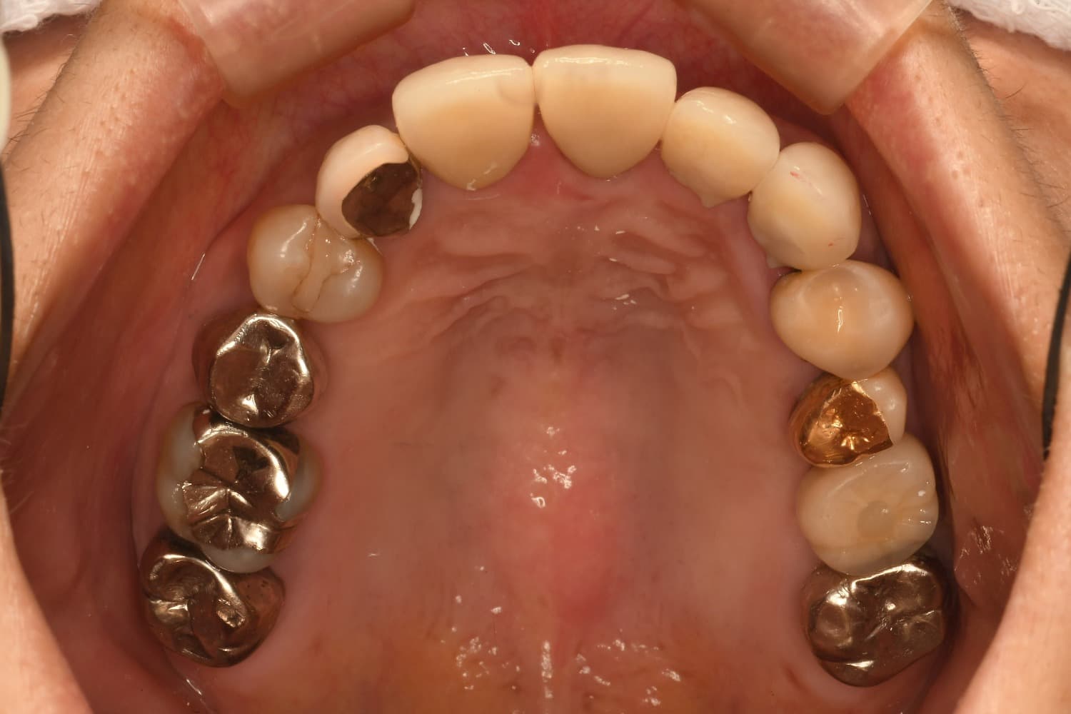 症例②インプラント治療後