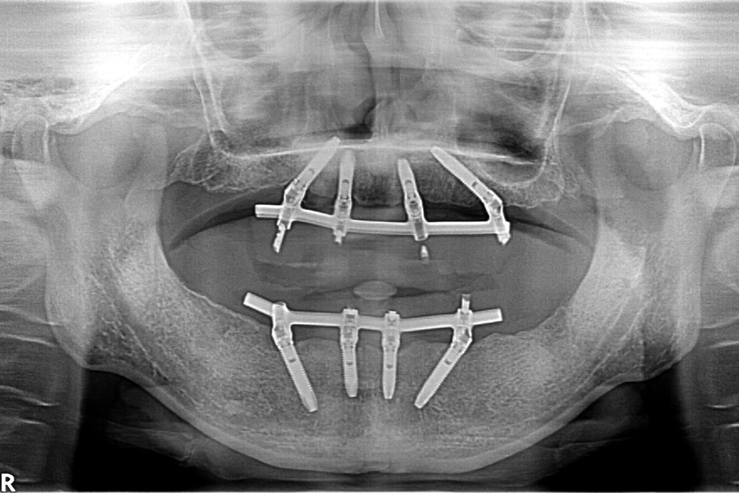 症例①インプラント治療後