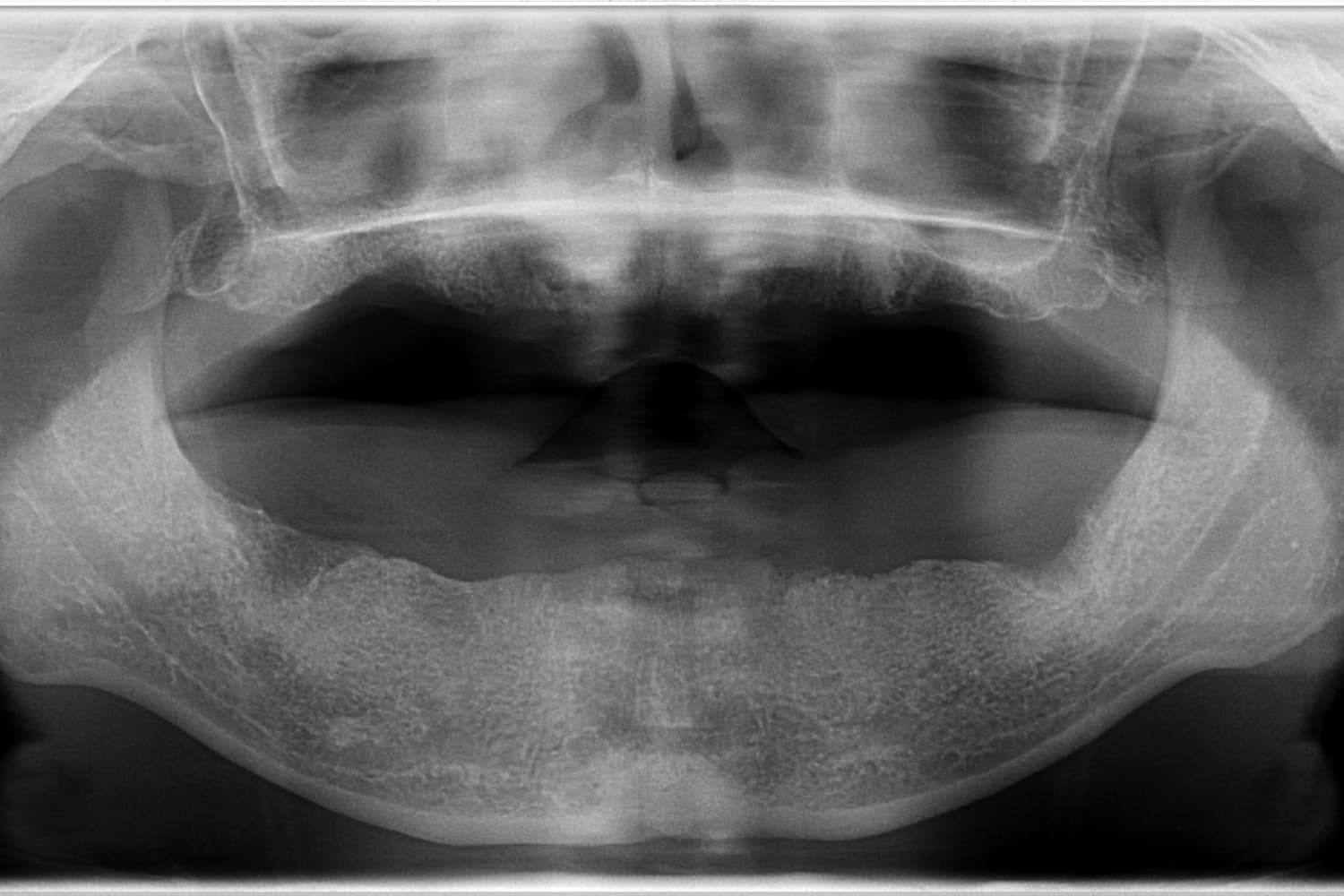 症例①インプラント治療前