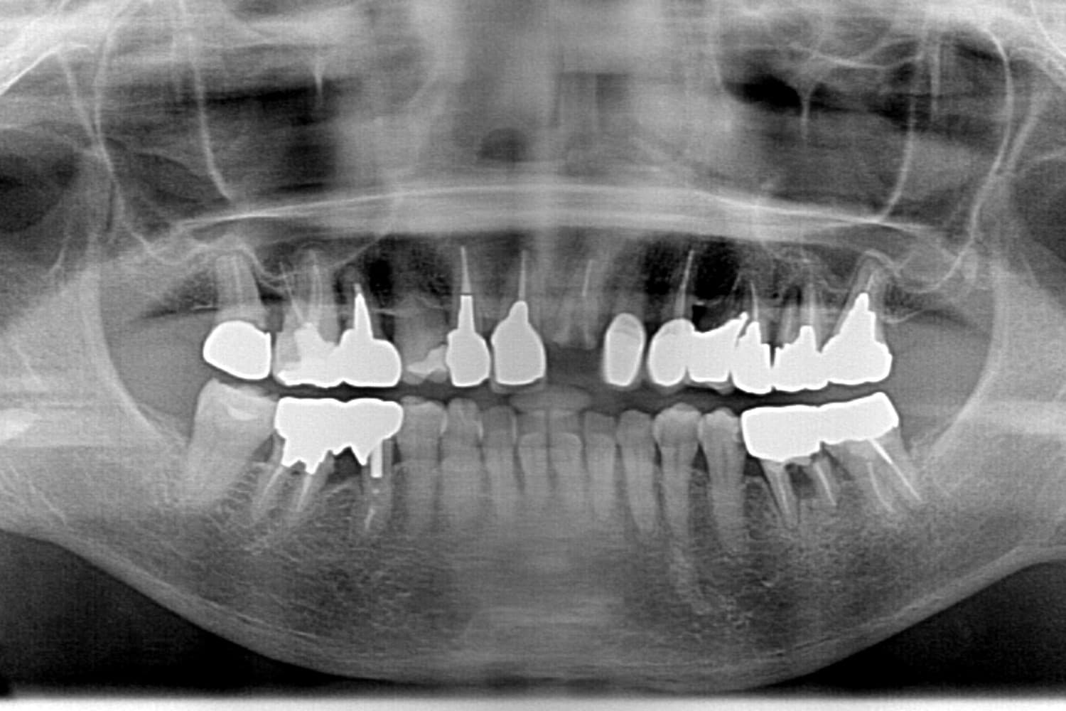 症例②インプラント治療前