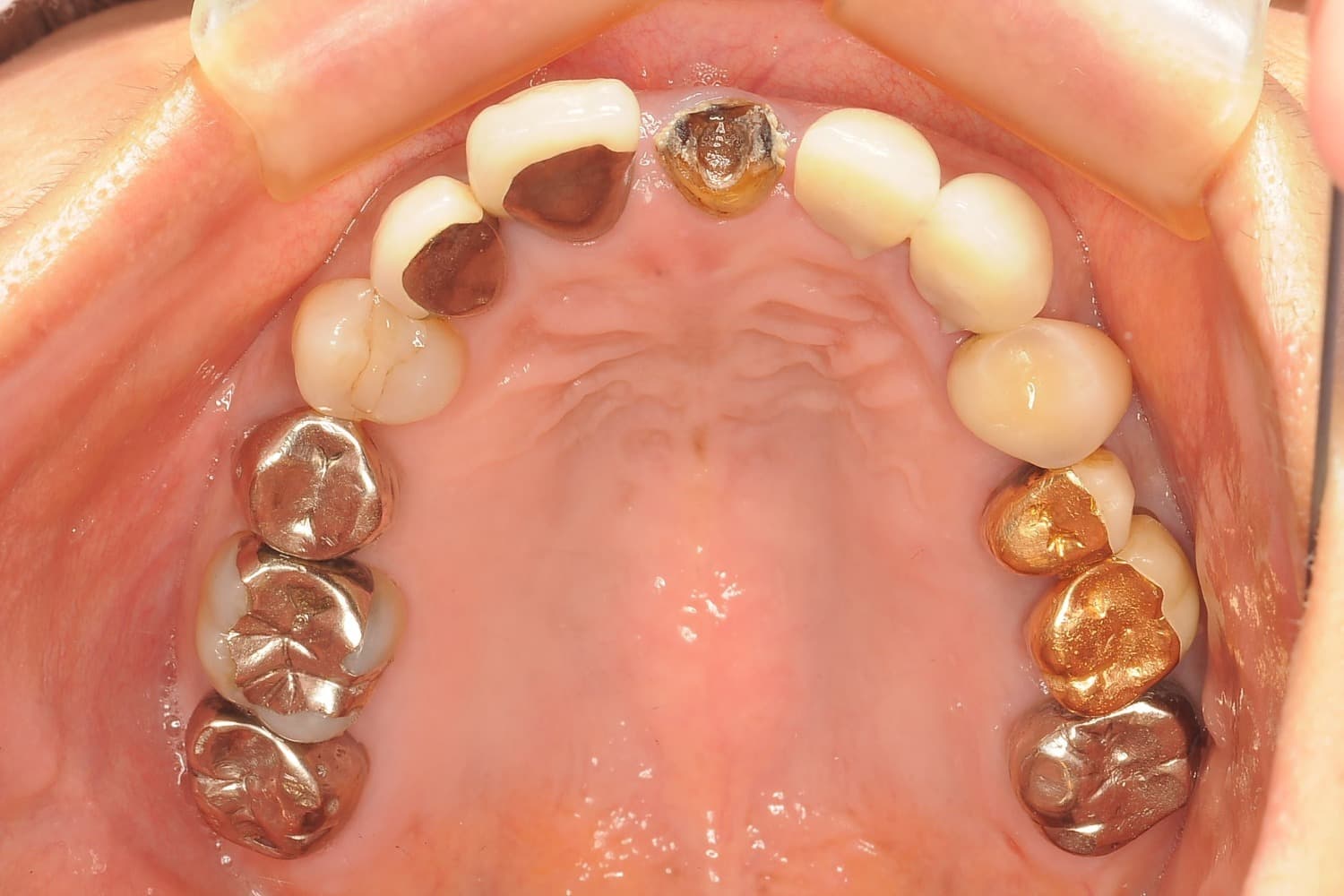 症例②インプラント治療前