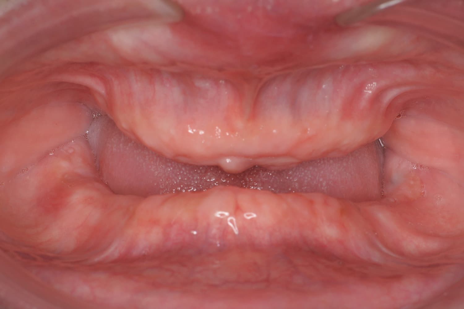 症例①インプラント治療前